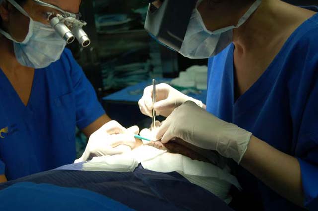 Team collects grafts using FUE method