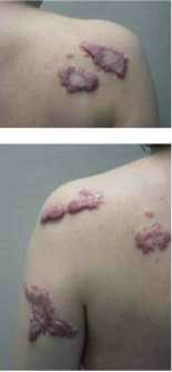 Pacjentka lat 42 z licznymi bliznowcami skóry pleców