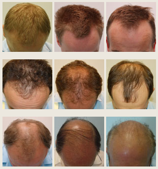 łysienie - wypadanie włosów u mężczyzn