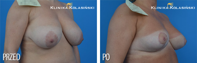 Pictures before and after: Breast lift