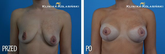 Pictures before and after: Breast lift