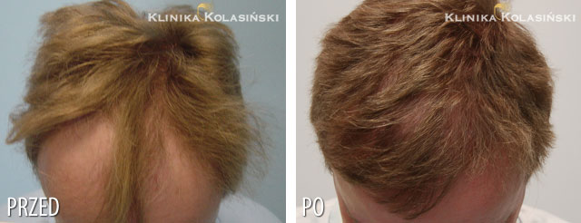 Przeszczep włosów - zdjęcia przed i po - Liczba przeszczepionych zespołów mieszkowych: 2800