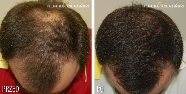 Przeszczep włosów - zdjęcia przed i po - Liczba przeszczepionych zespołów mieszkowych: 4200