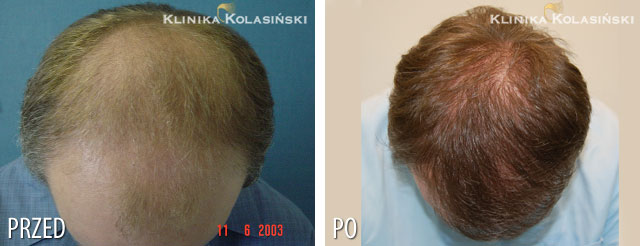 Przeszczep włosów - zdjęcia przed i po - Liczba przeszczepionych zespołów mieszkowych: 4360