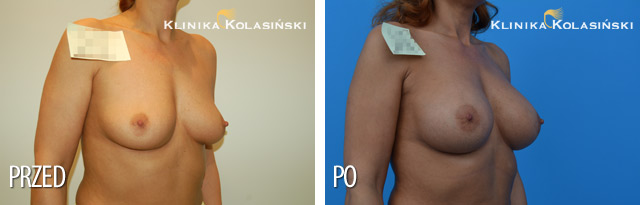 Bilder vorher und nachher: Bruststraffung 