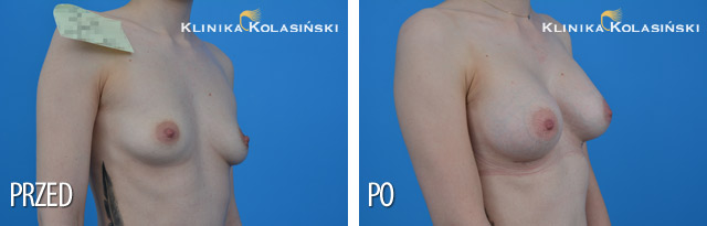 Wszczepienie protez pod mięsień piersiowy większy i gruczoł piersiowy protez anatomicznych po str prawej MF 295g, po str lewej MM 280 g (Allergan) technią Dual plane 2. Wszczepienie protez pod mięsień piersiowy większy i gruczoł piersiowy protez anatomicznych po str prawej MF 295g, po str lewej MM 280 g (Allergan) technią Dual plane 2.