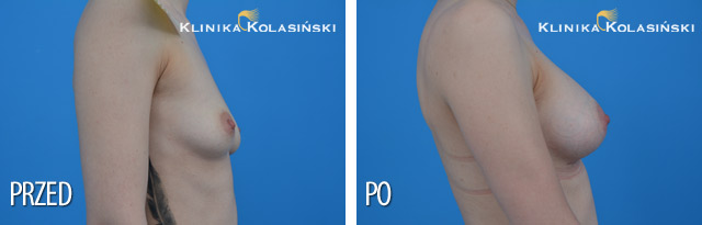 Wszczepienie protez pod mięsień piersiowy większy i gruczoł piersiowy protez anatomicznych po str prawej MF 295g, po str lewej MM 280 g (Allergan) technią Dual plane 2. Wszczepienie protez pod mięsień piersiowy większy i gruczoł piersiowy protez anatomicznych po str prawej MF 295g, po str lewej MM 280 g (Allergan) technią Dual plane 2.