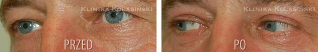 Before and after pictures: Eyelids Correction