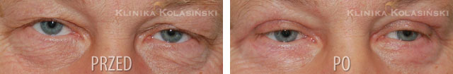 Before and after pictures: Eyelids Correction