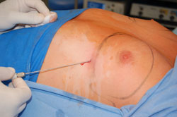Soaking the operated area with right fluid significantly reduces intra-operative bleeding