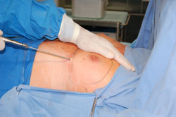 Suction of adipose tissue with a thin cannule