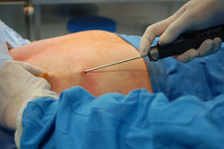 Glandular tissue is being removed with the shaver