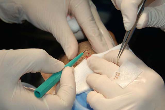 Bild 1 - Transplantatenentnahme mittels der FUE-Methode aus dem Bart
