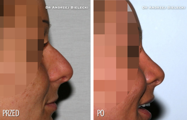 Bilder vorher und nachher: Nasenkorrektur
