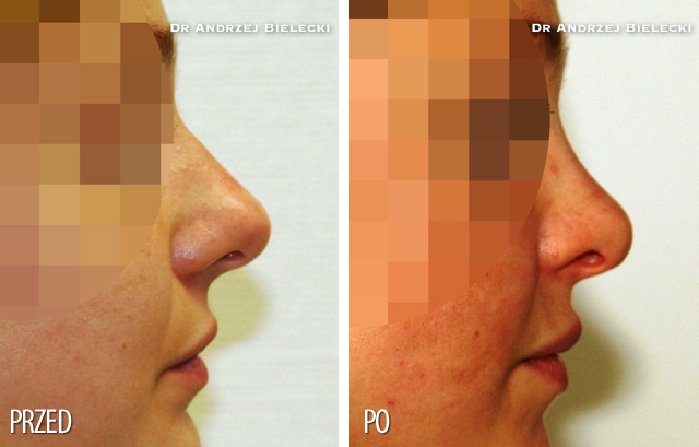 Rhinoplasty – Before and After Pictures