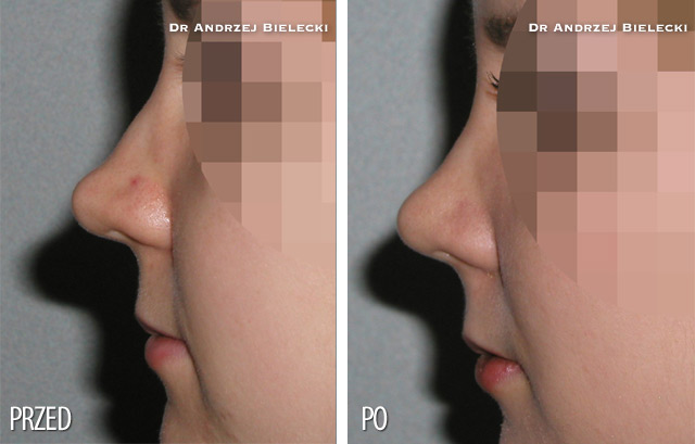 Bilder vorher und nachher: Nasenkorrektur