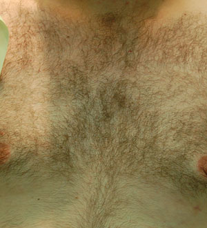 BHT – Body Hair Transplant – Hair grafts taken from other parts of the body  - Kolasiński Clinic