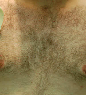 BHT - Body Hair Transplant - Przeszczep Włosów z Innych Części Ciała