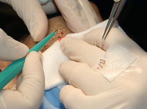 BHT - Body Hair Transplant - Hair grafts taken from other parts of the body