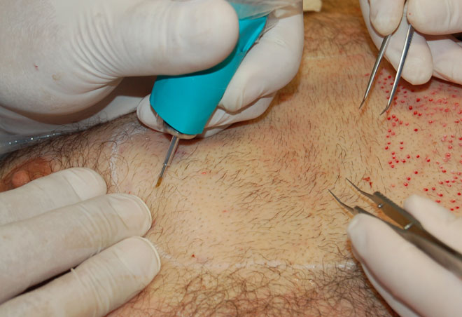 BHT - Body Hair Transplant - Hair grafts taken from other parts of the body