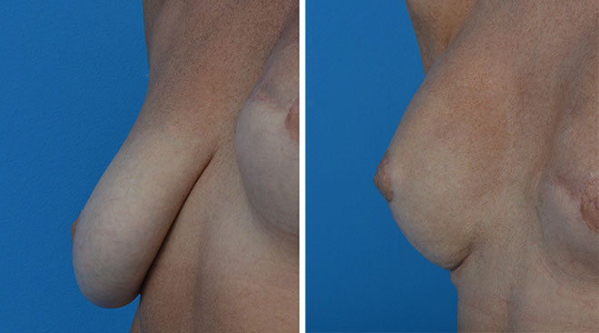 Pierś opadająca przed i po operacji profilaktycznej mastektomii połączonej z zabiegiem podniesienia piersi i wszczepienia implantu anatomicznego