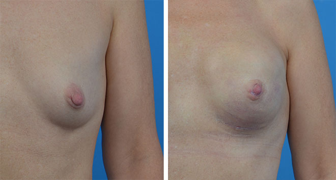 Pierś pacjentki przed profilaktyczną mastektomią i po podskórnej mastektomii połączonej z rekonstrukcją piersi implantem anatomicznym.
