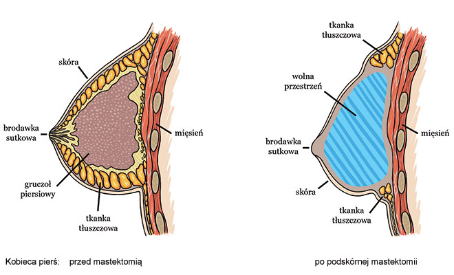kobieca pierś przed i po mastektomii