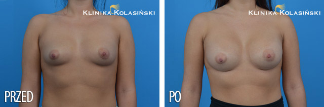 Zdjęcia przed i po: Powiększanie piersi