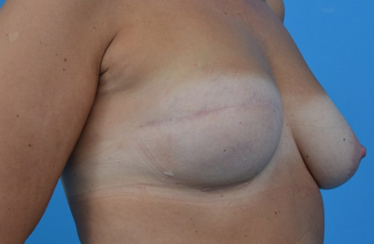 Całkowicie zrekonstruowana pierś prawa przeszczepem tkanki tłuszczowej. Rekonstrukcja kompleksu brodawka-otoczka sutkowa będzie ostatnim etapem odtworzenia naturalnej piersi.