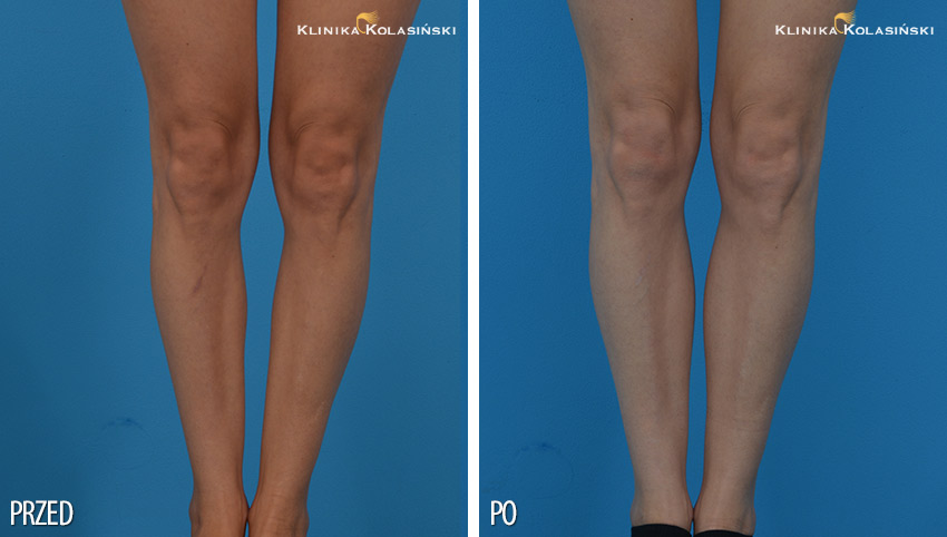 Zdjęcia przed i po: Korekcja łydek