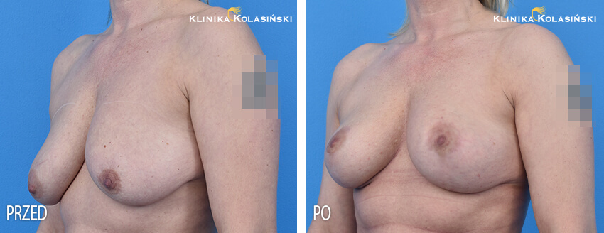 Podniesienie piersi - Klinika Kolasiński