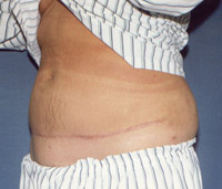 Abdominoplastyka platyka brzucha