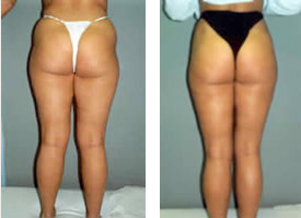 Liposukcja - odsysanie tłuszczu - Przed i Po