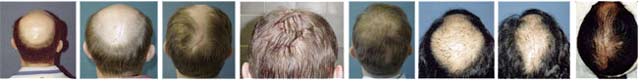 Zabieg scalp reduction połączony z plastyką z użyciem płatów zakończony zabiegiem przeszczepu włosów, pozwala na zlikwidowanie nawet bardzo rozległej łysiny.