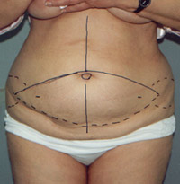 Abdominoplastyka - Plastyka brzucha