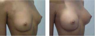 Pacjentka lat 32 przed zabiegiem powiększania piersi; Stan po zabiegu