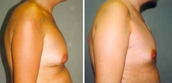 pacjent lat 28 z ginekomastią oraz pacjent pół roku po zabiegu liposuction piersi