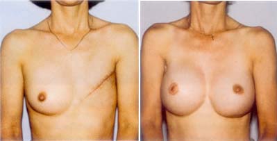 Pacjentka lat 45 po amputacji lewej piersi z powodu raka i ta sama pacjentka 1 rok po rekonstrukcji piersi i brodawki piersiowej