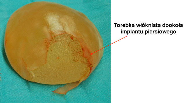 Torebka włóknista dookoła implantu piersiowego