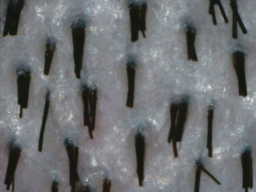 Łysienie androgenowe - Prawidłowy obraz mikroskopowy przedstawiający zespoły mieszkowe składające się z grubych włosów anagenowych