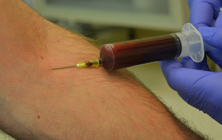 Pobieranie krwi pacjenta do probówki wypełnionej preparatem przeciwkrzepliwym