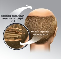 Operacja - przeszczep włosów