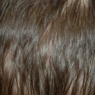 Przeszczep włosów - metoda FUE - brak blizny