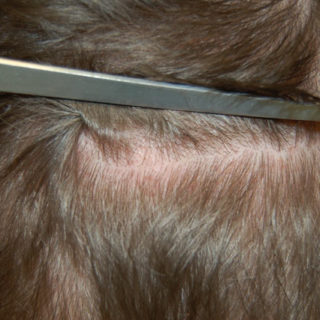 Przeszczep włosów - metoda FUE - brak blizny
