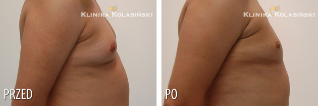 Pictures before and after: Gynaecomastia