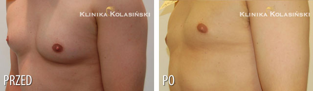 Pictures before and after: Gynaecomastia