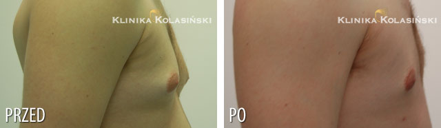 Ginakomastia - Zdjęcia przed i po