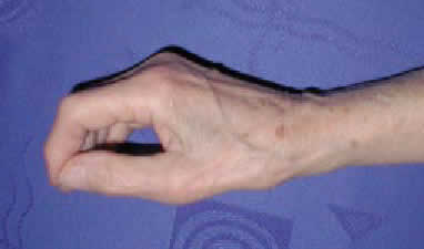 Zespół cieśni nadgarstka -widoczny zanik mięśni kłębu kciuka