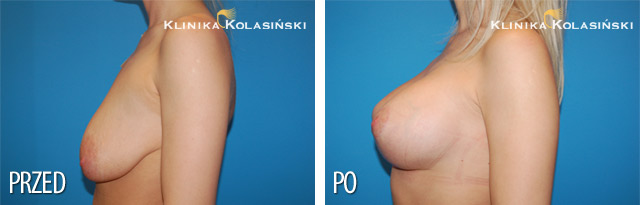 Podniesienie piersi - zdjęcia przed i po