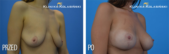 Podniesienie piersi sposobem Lejour z wszczepieniem implantów okrągłych o poj. 310 ml (Allergan) pod powięź mięsnia piersiowego większego.
